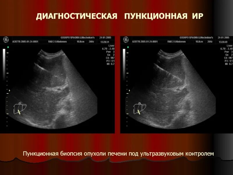 Пункционная биопсия печени. Чрескожная пункционная биопсия печени. Пункционная биопсия под контролем УЗИ. Пункционная биопсия опухоли.