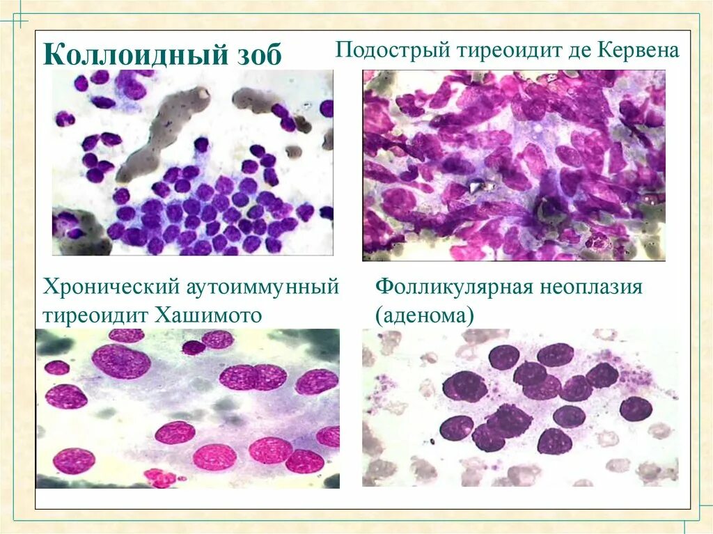 Хронический тиреоидит гистология. Макропрепарат тиреоидит Хашимото. Коллоидный зоб гистология. Цитограмма коллоидного зоба.