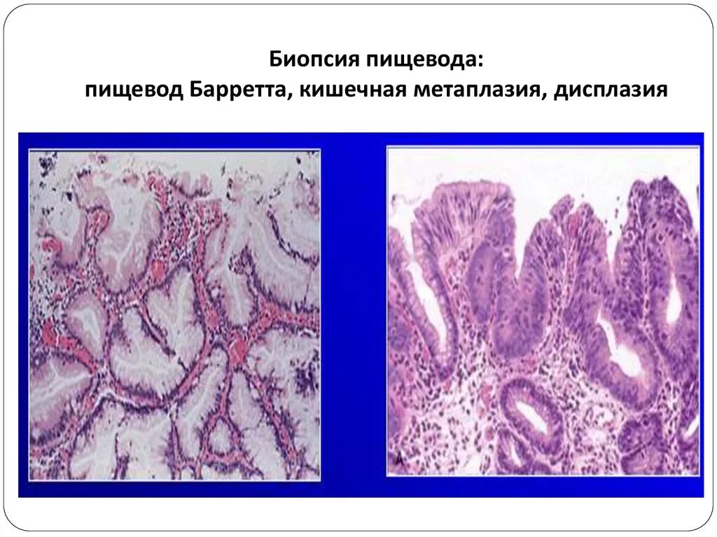 Биопсия пищевода