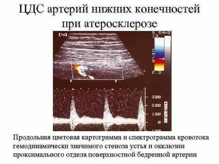 Атеросклероз нижних конечностей узи