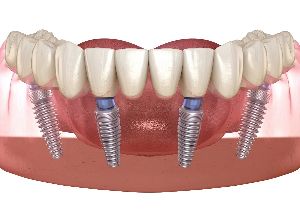 Имплантация зубов all on 6. Имплантация челюсти на 4 имплантах. Имплант зуба Osstem.