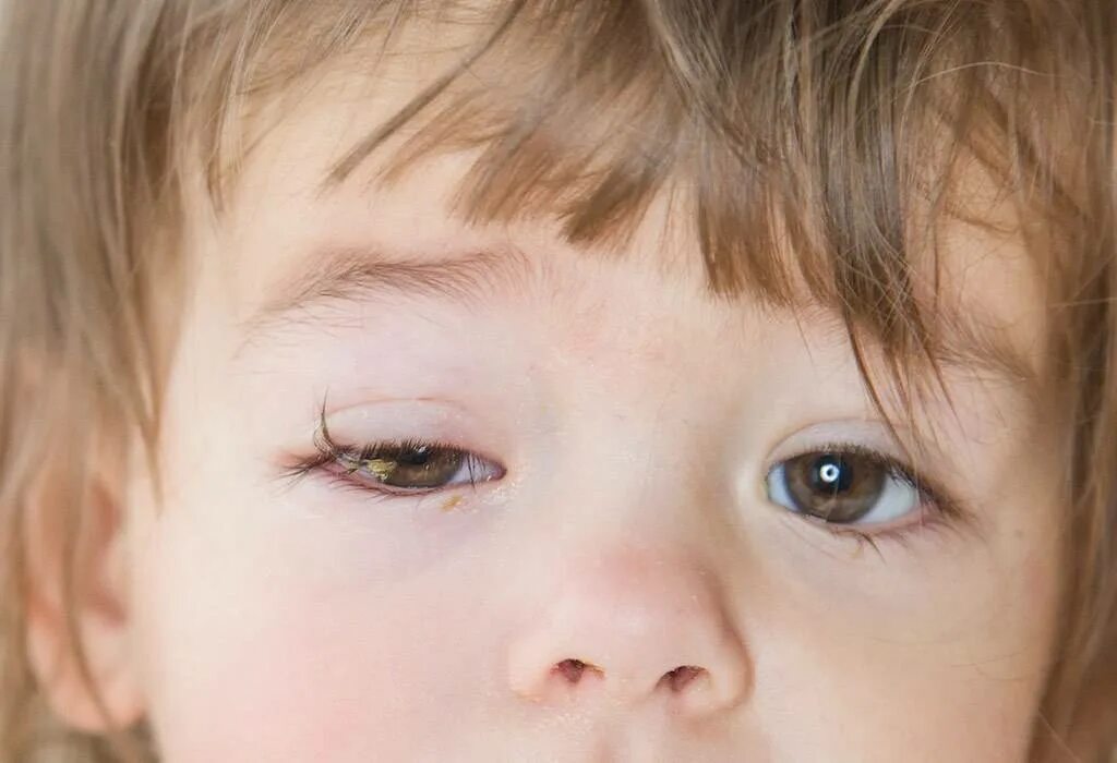 Детская глазная болезнь. Аллергический коньюктивит. Острый атопический конъюнктивит.