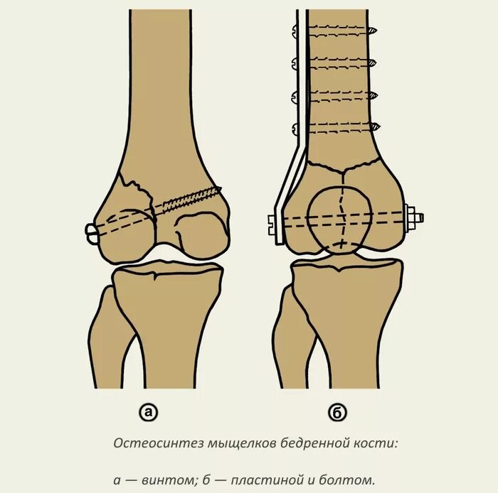 Мыщелок бедренной. Перелом мыщелка бедренной кости. Остеосинтез мыщелков бедренной кости. Внесуставной остеосинтез. Перелом мыщелка остеосинтез.