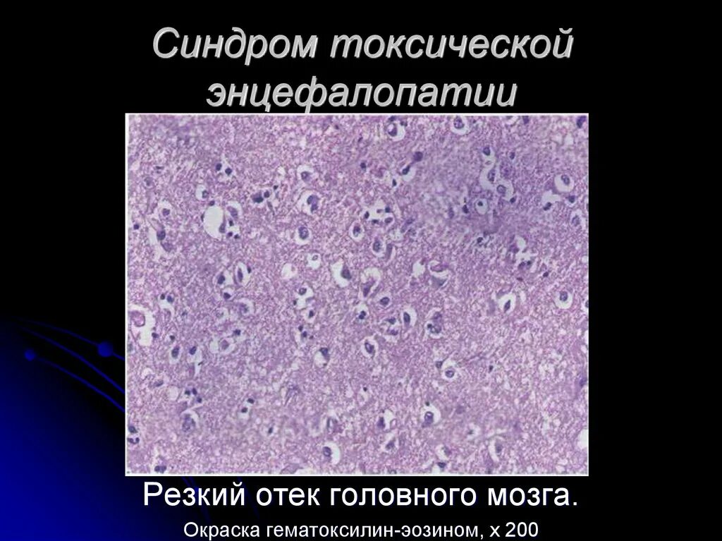 Резидуальная энцефалопатия на мрт. Поражение головного мозга врожденное. Токсическая энцефалопатия кт. Энцефалопатия головного мозга что это такое. G92 токсическая энцефалопатия.