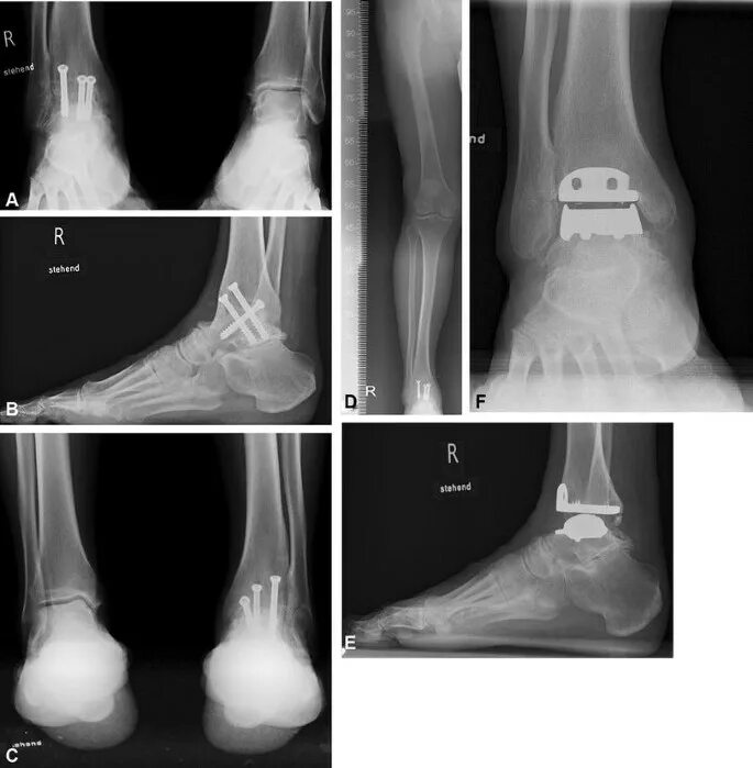 Артродез голеностопного сустава. Артродез голеностопного сустава Han. Артродез голеностопного сустава рентген. Артроз голеностопного сустава операция.