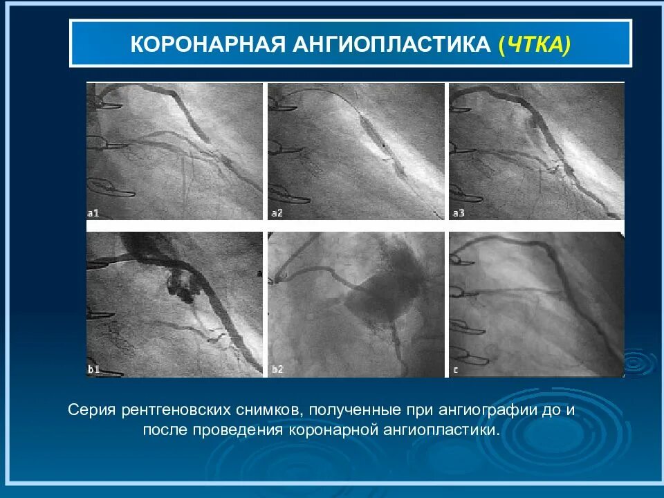 Баллонная коронарная ангиопластика. ТРАНСЛЮМИНАЛЬНАЯ коронарная ангиопластика. Коронная ангионопластика. Ангиопластика при инфаркте миокарда. Коронарная ангиография при инфаркте миокарда.