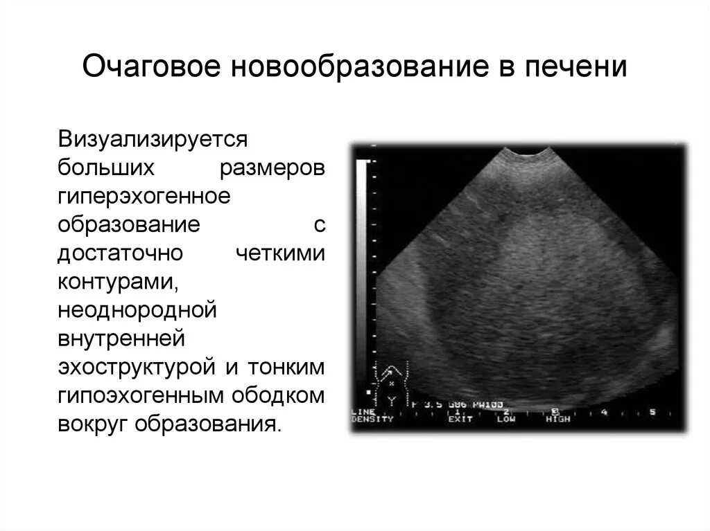 Очаговые образования в печени на УЗИ. Гиповаскулярный очаг левой доли печени. Новообразование в печени на УЗИ. Округлые образования печени