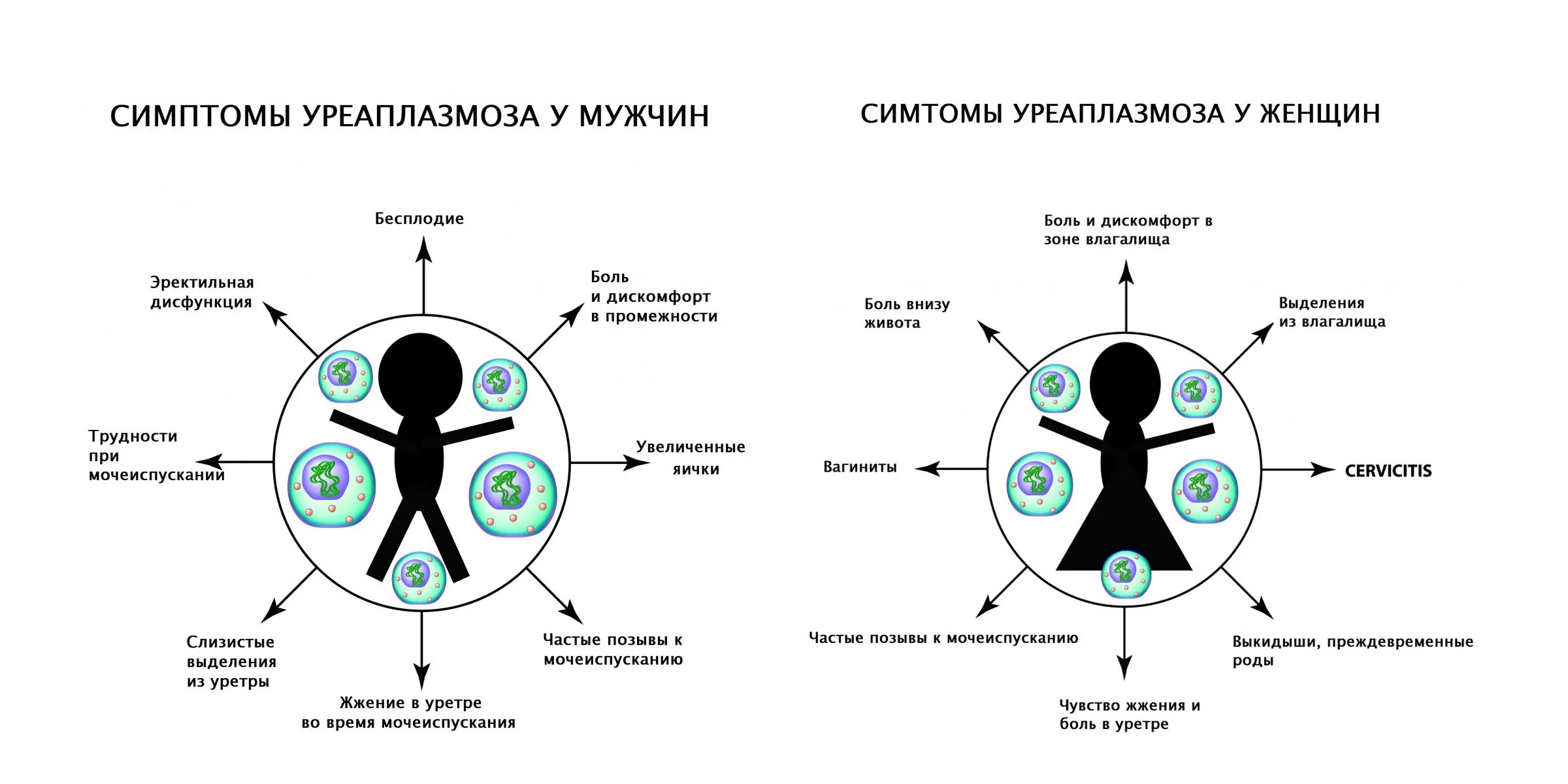 Бесплодие у женщин. Уреаплазмоз причины возникновения. Симптомы уреаплазмоза у женщин.