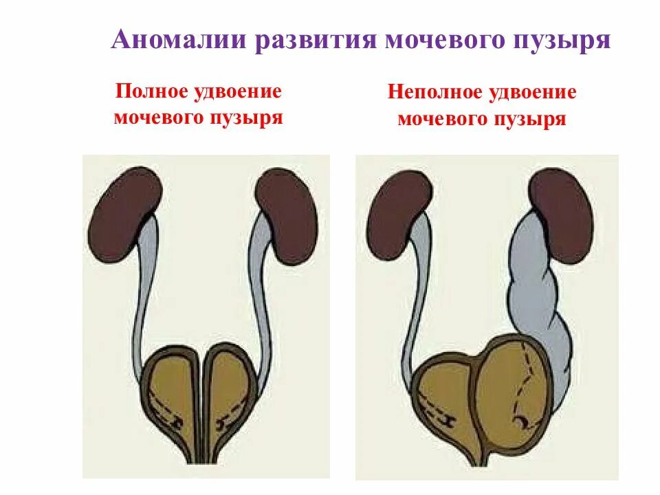 Аномалии развития органов мочевыделительной системы. Пороки развития мочевого пузыря. Врожденные аномалии мочевого пузыря. Аномалии мочевого пузыря классификация.