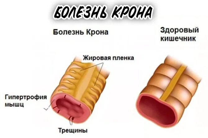 Болезнь крона кишечника симптомы лечение. Болезнь крона тонкой кишки. Болезнь крона тонкой кишки симптомы. Болезнь крона кишечник. Симптомы болезни короны.