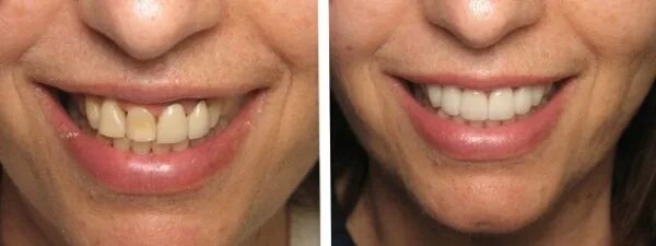 после протезирования щека. после протезирования щека. имплантация зубов до и после. дистальный прикудо и после. лицо при отсутствии зубов.