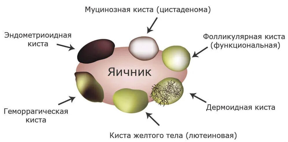 Киста o rads. Строение фолликулярной кисты. Функциональные кисты яичников. Фолликулярная (функциональная) киста. Фолликулярные кисты яичников симптомы.