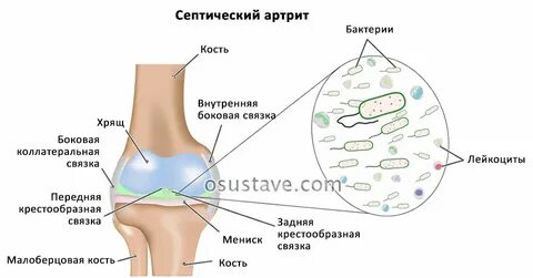 Инфекционный артрит суставов