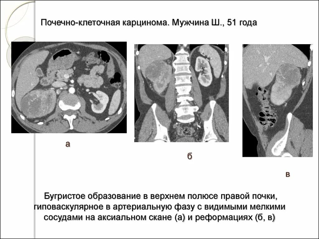 Образования в почке у мужчин. Переходно клеточная карцинома почки. Почечно-клеточная карцинома почки на кт. Переходно-клеточная карцинома почек кт. Светлоклеточная карцинома почки кт.