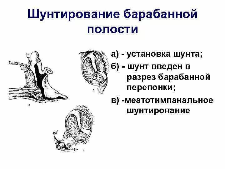 Шунты в уши ребенку. Шунт барабанной перепонки. Парацентез разрез барабанной перепонки. Экссудативный отит шунтирование. Парацентез барабанной перепонки шунтирование.