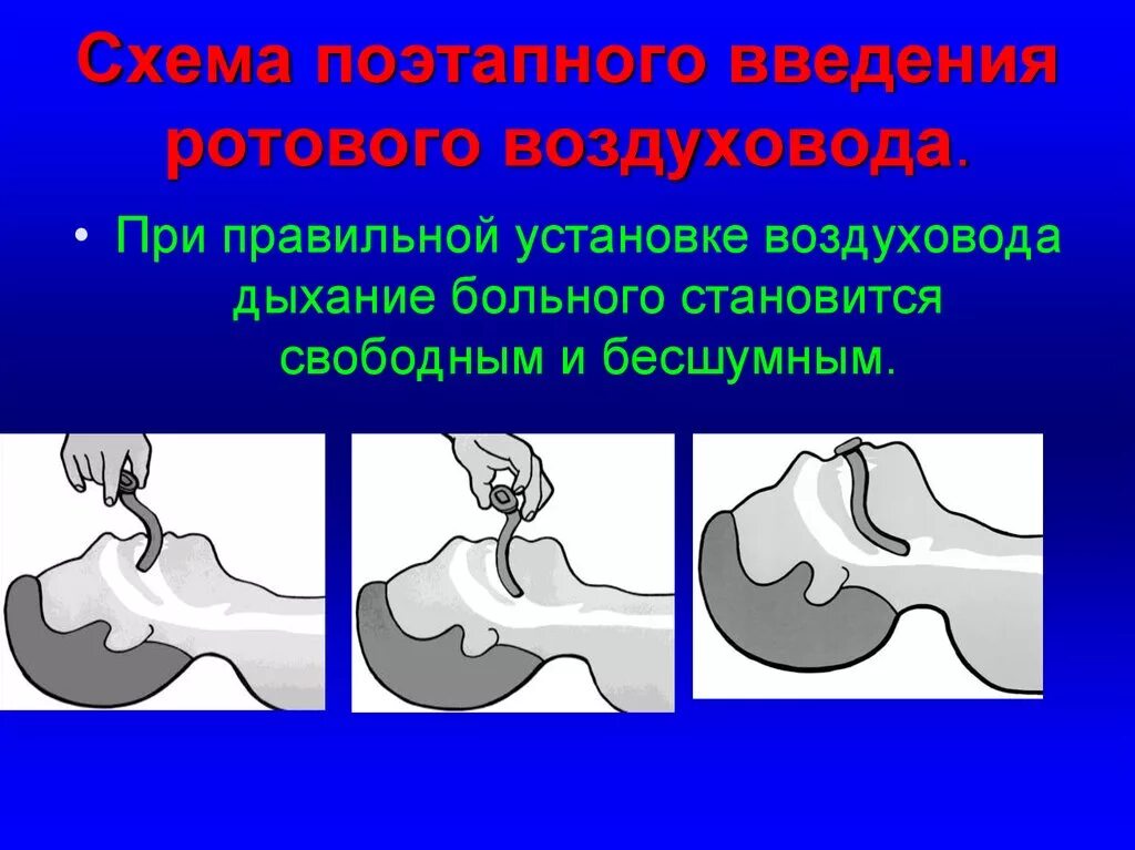 Воздуховод алгоритм. Введение воздуховода алгоритм. воздуховод медицинский алгоритм. техника постановки воздуховода. введение воздуховода при слр.
