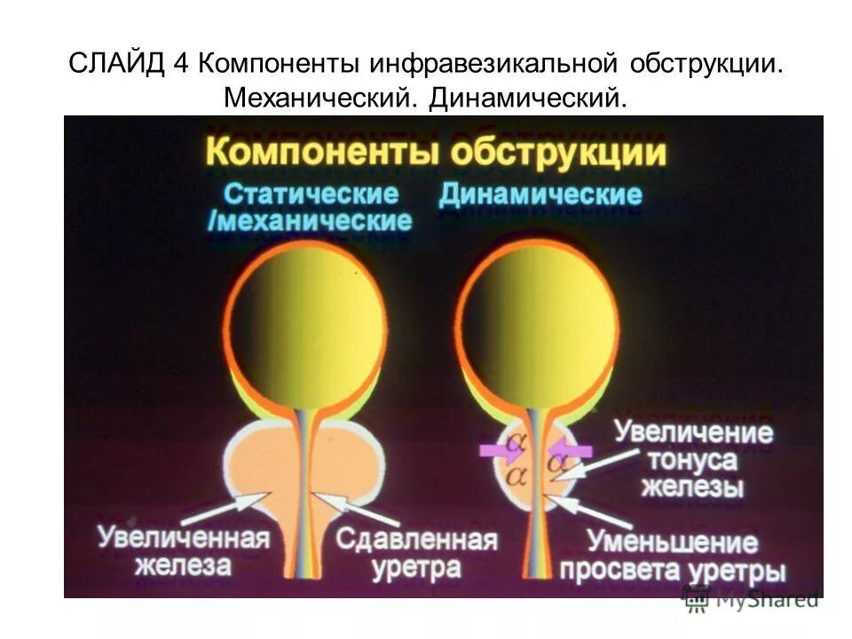 Железистая гиперплазия предстательной железы. Инфравезикальная обструкция. Инфоавезикулярная обструкция. Интравезикальная обструкция. Инфравезикальной обструкции мочевого пузыря.