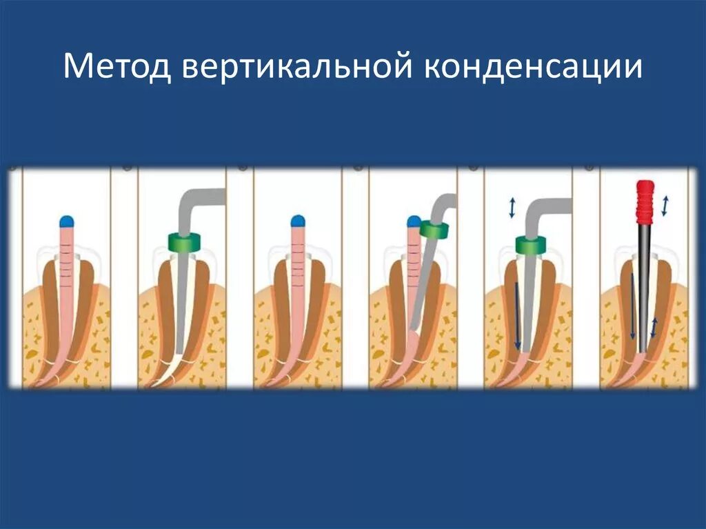 Методы пломбирования корневых. Вертикальная конденсация гуттаперчи методика. Метод вертикальной конденсации гуттаперчи. Метод вертикальной конденсации разогретой гуттаперчи. Метод вертикальной конденсации для пломбирования корневых каналов.