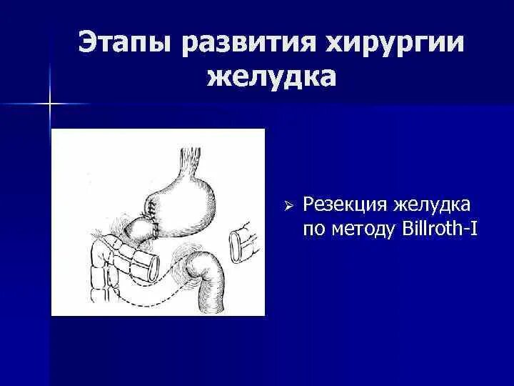 Язва операция сколько. Резекция желудка этапы операции. Резекция желудка и ДПК. Зажим хирургический для резекции желудка. Резекция желудка Оперативная хирургия.