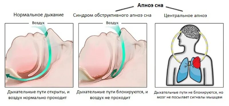 Синдром обструктивного апноэ сна симптомы. СОАС синдром обструктивного апноэ сна. Синдром обструктивного апноэ сна у ребенка. Синдром центрального апноэ.