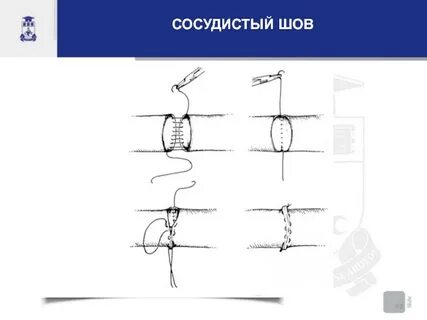 Основные виды сосудистого шва