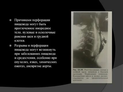 Перфорация пищевода