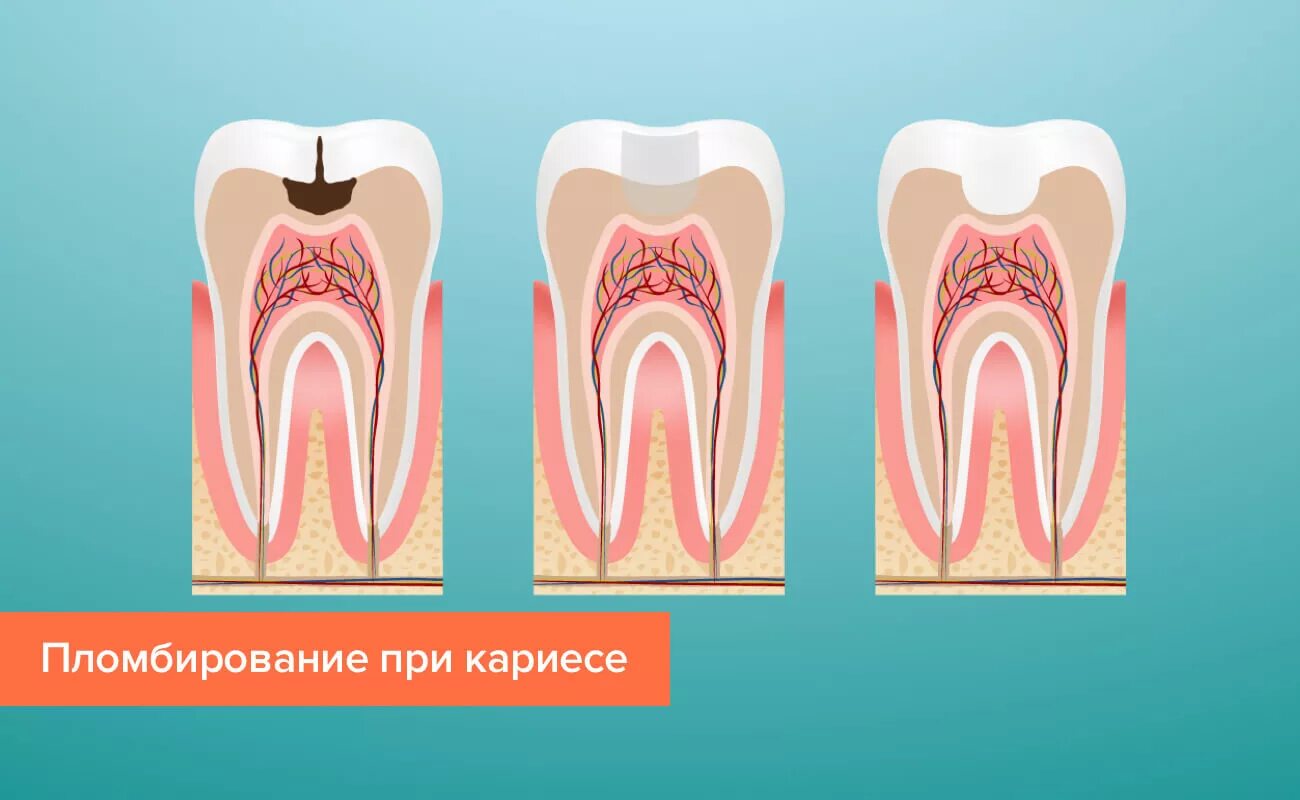 Пломбирование зуба после лечения каналов