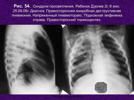 Диагноз правосторонний