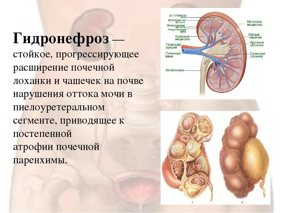 Причины расширения лоханки