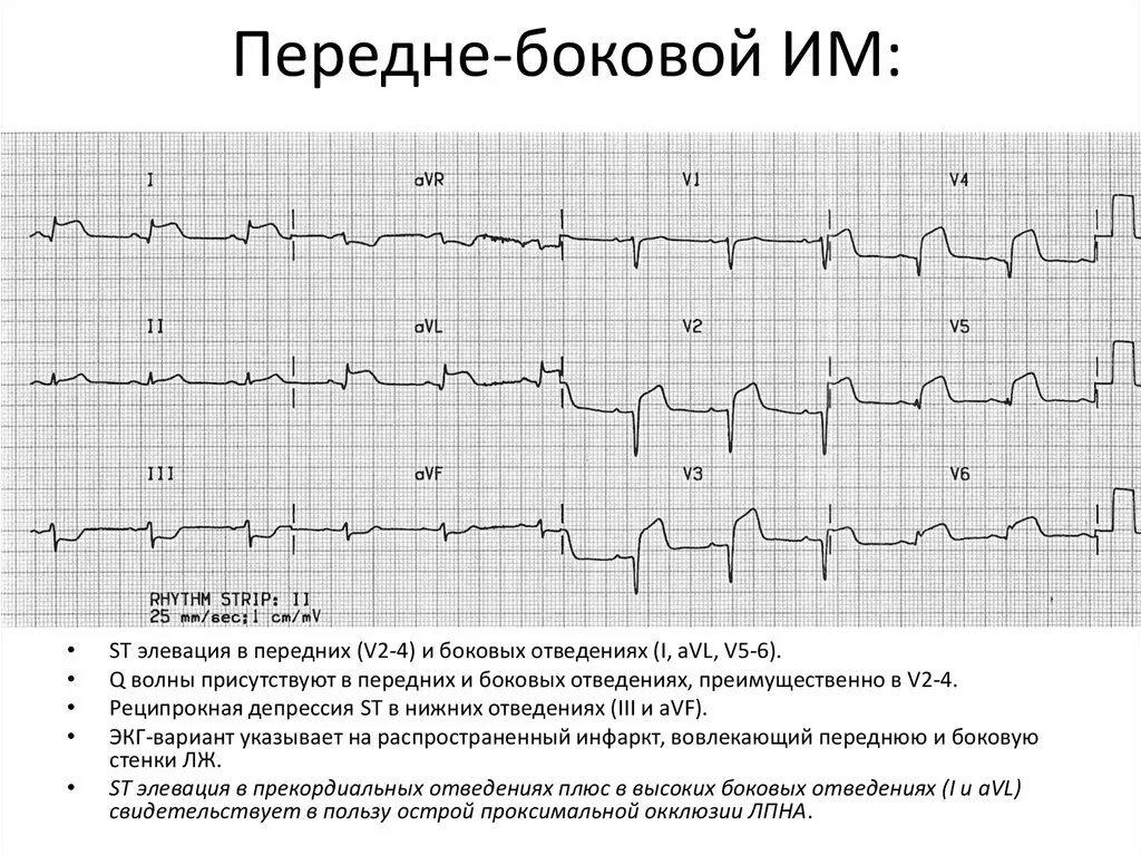 Изменение миокарда передне перегородочной области. ЭКГ при переднебоковой инфаркт миокарда. Передне-перегородочный инфаркт миокарда на ЭКГ. ЭКГ инфаркта миокарда передне боковой стенки. Инфаркт миокарда передне перегородочный верхушечный.