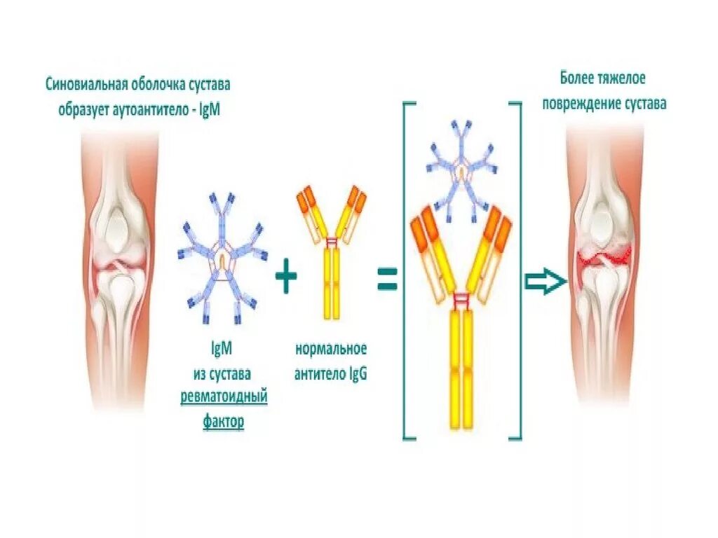 Ревматоидный артрит ревматоидный фактор. Ревматоидный фактор IGM что это. Ревматоидные факторы ультрачувствительный. Ревматоидный фактор при ревматоидном артрите.