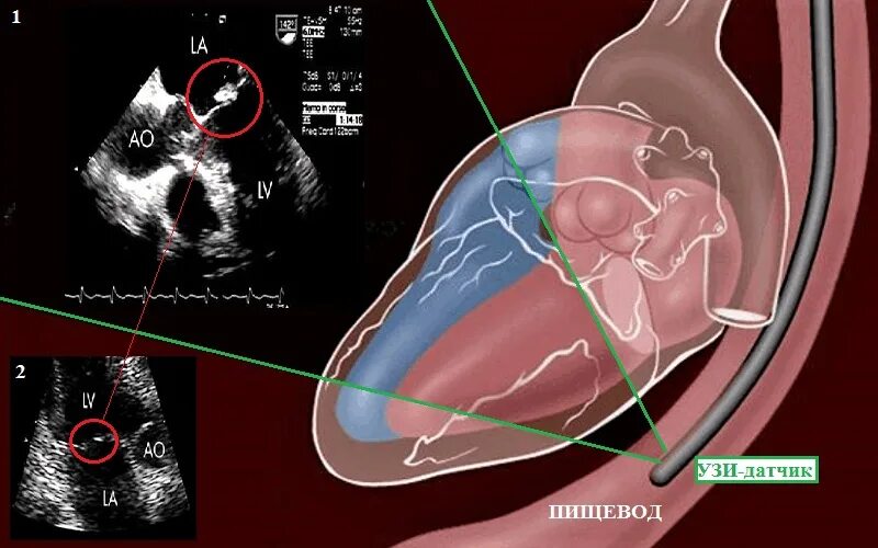 Узи через пищевод. Эхокардиография Эхо кг УЗИ сердца. Чреспищеводная эхокардиография сердца. Чреспищеводная эхокардиография (ЧПЭХОКГ). Трансторакальная эхокардиография показания.