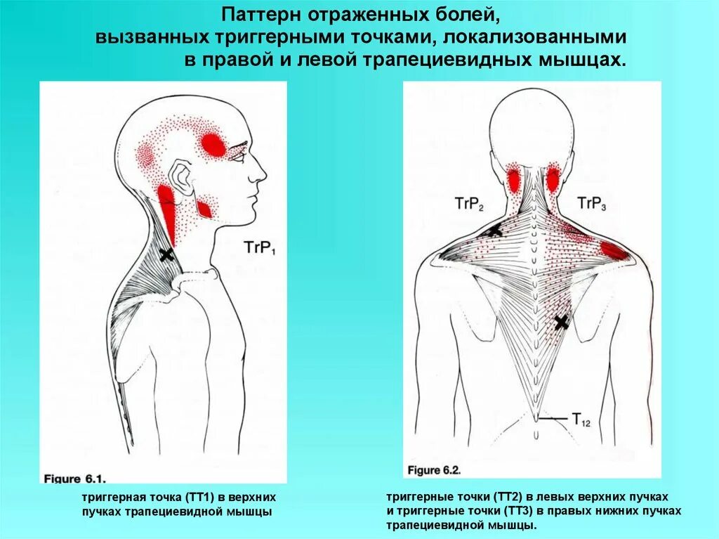 Иррадиация боли в нижнюю челюсть. Тт1 триггерная точка. Миофасциальные триггерные точки спины. Ременная мышца головы триггерные точки.