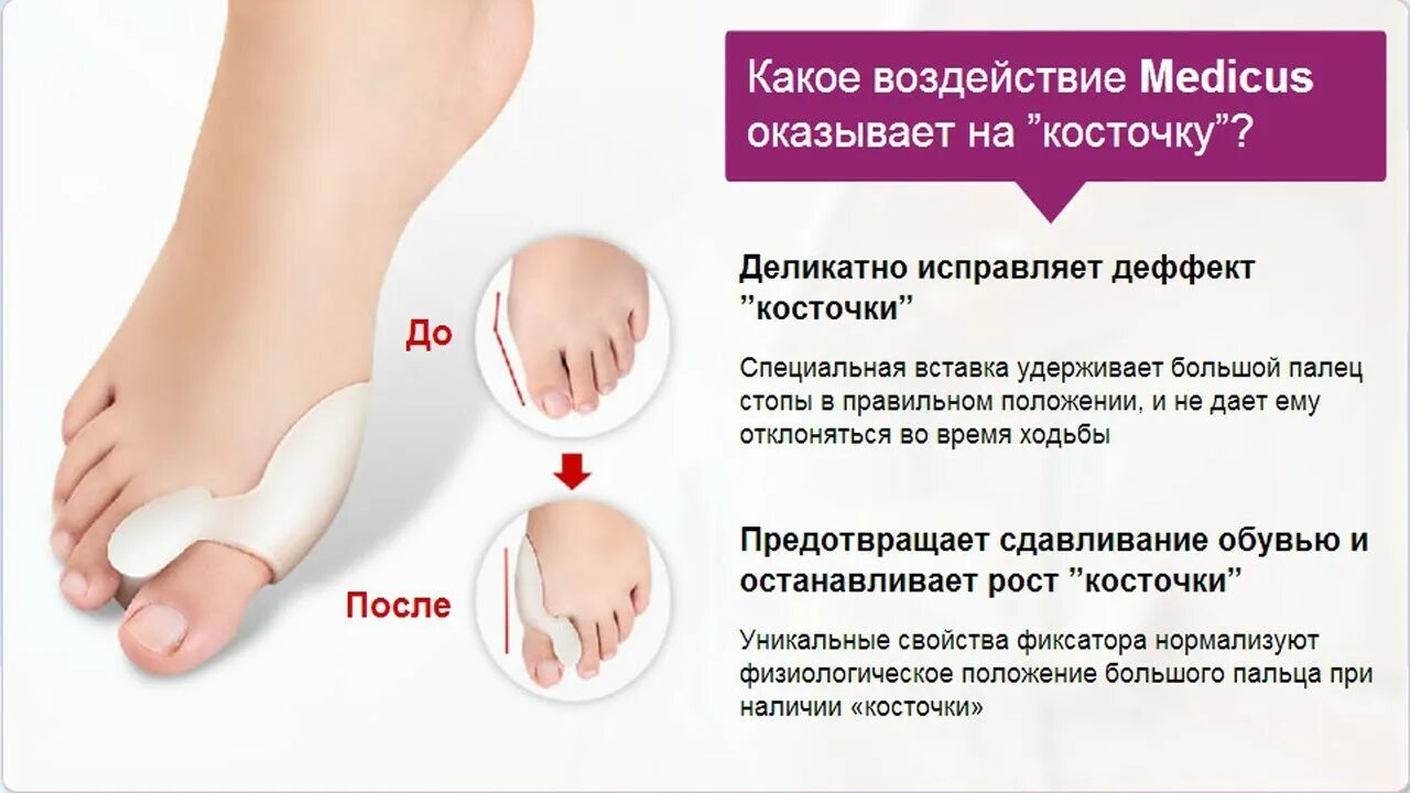 Фиксатор "valgus Pro" (вальгус про). Корректор для большого пальца valgus Pro (вальгус про). Фиксатор от косточки. Фиксатор для косточки на ноге.