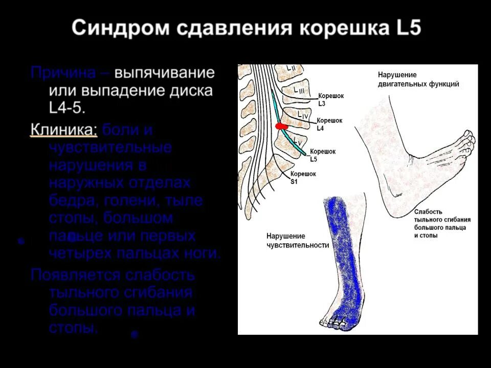 Поражение корешковых нервов. Синдром компрессии корешка s1. Корешок s1 парез стопы. Тильное згиннание стопі нерв.