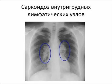 Внутригрудная лимфаденопатия