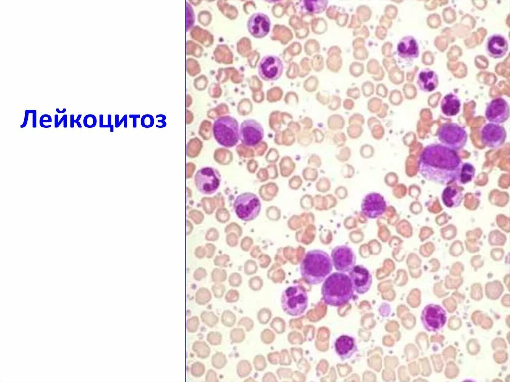Снижение лейкоцитоза. Лейкоцитоз микроскопия. Нейтрофильный лейкоцитоз препарат. Лейкемический лейкоцитоз. Лейкоцитоз моноцитоз нейтрофилез.