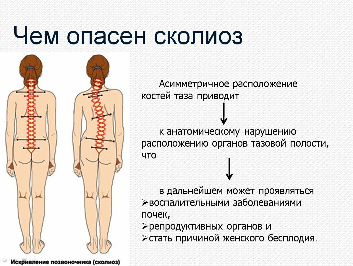 Ранний сколиоз. Сколиоз позвоночника первая стадия. сколиоз позвоночника у детей 1 степени. сколиоз 1 степени искривления позвоночника. сколиотическая деформация позвоночника.