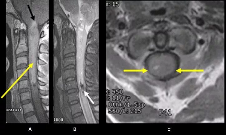 Интрамедуллярная опухоль спинного мозга мрт. Эпендимома спинного мозга. Интрамедуллярная киста мрт. Интрамедуллярные опухоли спинного