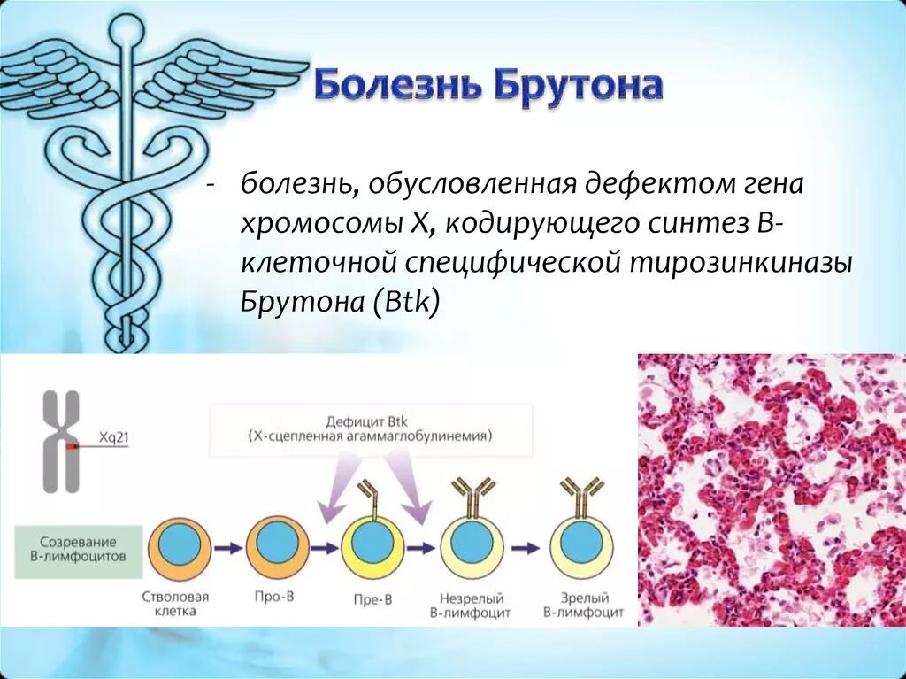 Иммунодефицит брутона. Агаммаглобулинемии Брутона). Тирозинкиназы Брутона. Проявления агаммаглобулинемии Брутона. Механизм развития синдрома Брутона.