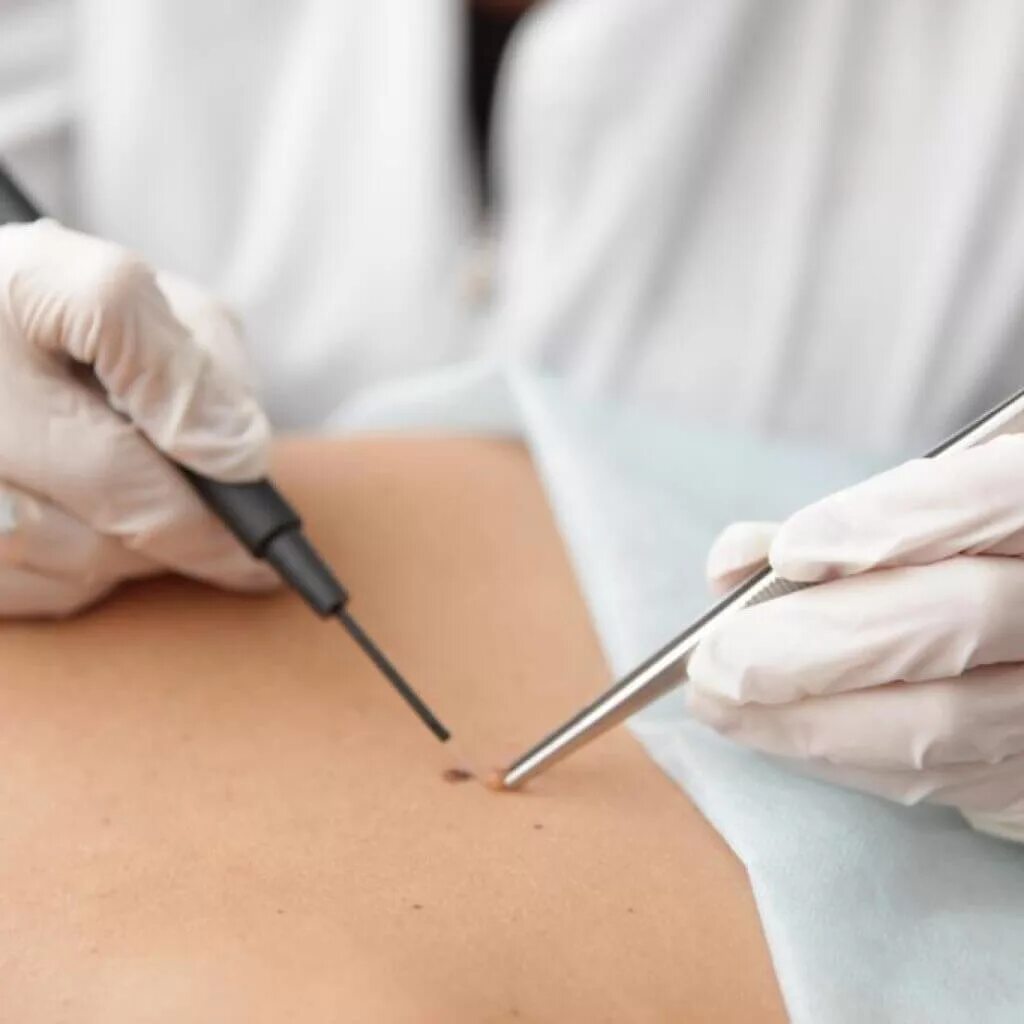 электрокоагуляция в косметологии. электрокоагуляция папиллом. криодеструкция новообразований кожи. удалить папилломы коагулятором. удалить папилломы коагулятором.