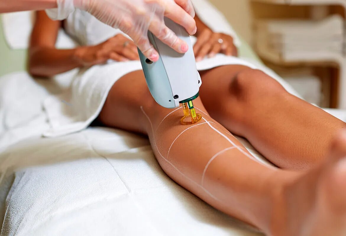 Лазерная эпиляция Candela GENTLELASE. IPL Laser hair removal. Candela GENTLELASE Pro Alexandrite Laser hair removal. Эпиляция александритовым лазером. Лазерная депиляция процедура