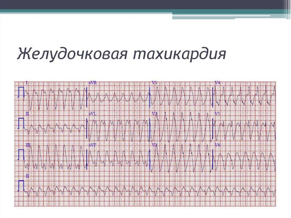 Желудочковая тахикардия на экг. Пароксизмальная тахикардия желудочков ЭКГ. Пароксизмальные неустойчивые желудочковые тахикардии ЭКГ. ЖТ тахикардия на ЭКГ.