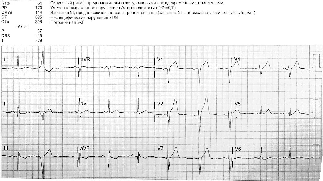 Умеренные изменения реполяризации. Коронарный зубец т на ЭКГ. Неспецифические нарушения реполяризации на ЭКГ. Пограничная ЭКГ. ЭКГ при нарушениях реполяризации сердца-.