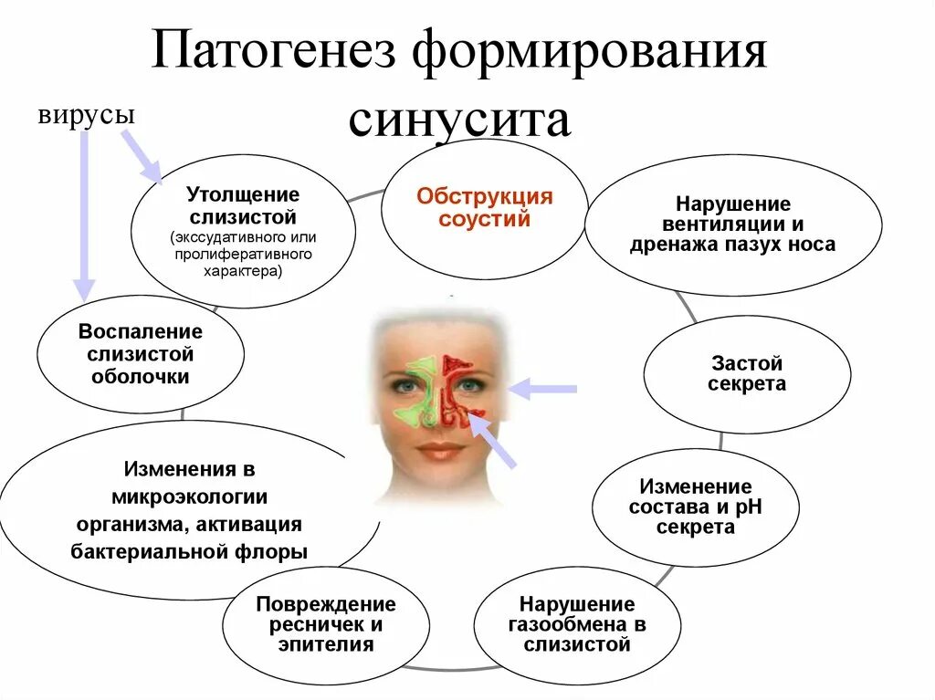 Острый одонтогенный синусит патогенез. Патогенез острого риносинусита. Патогенез острого одонтогенного синусита. Патогенез развития острого синусита. Заболевания связанные с носом