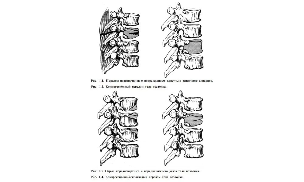Повреждения позвоночника переломы. Компрессионные переломы тел позвонков классификация. Компрессионный перелом позвоночника типа 1. Компрессионный перелом позвоночника th-5-6. Компрессионный перелом перелом 12 позвонка грудного.