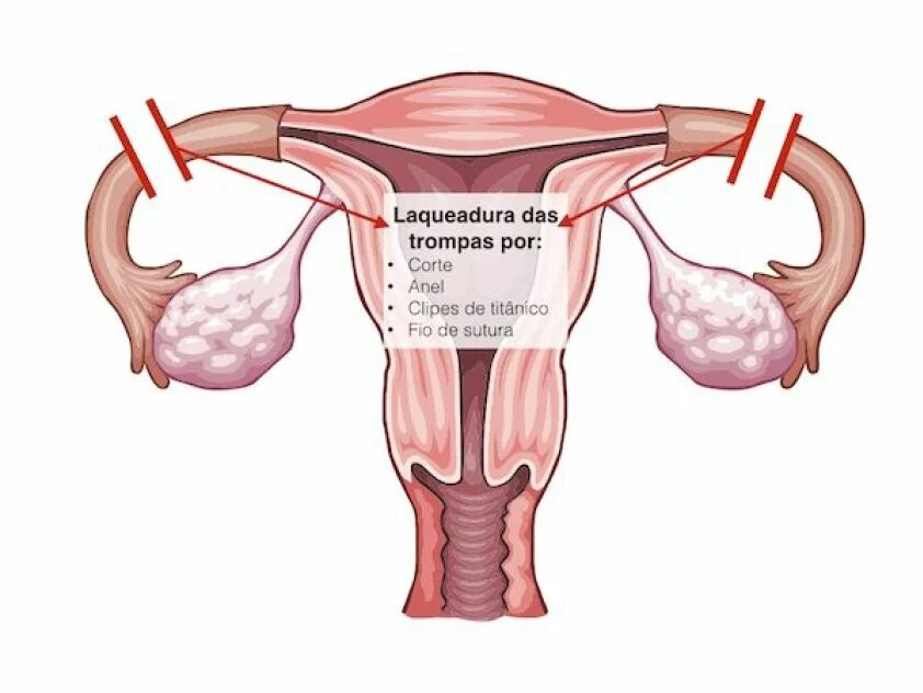 Как перевязывают трубы у женщин. Перевязка труб у женщин. Операция перевязка труб у женщин.