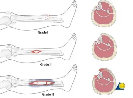Open fracture