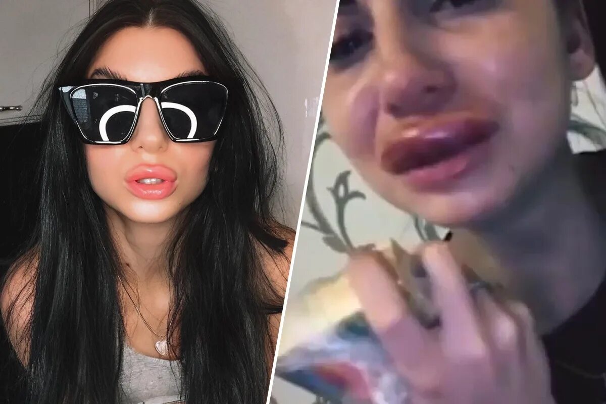 фрося накачала губы