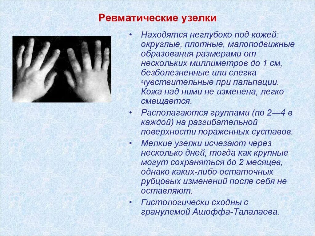 Ревматоидные узелки на коже как выглядят Острая ревматическая лихорадка презентация онлайн
